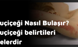 Suçiçeği Nasıl Bulaşır? Suçiçeği belirtileri nelerdir