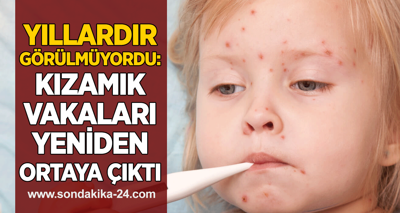Yıllardır görülmüyordu: Kızamık vakaları yeniden ortaya çıktı